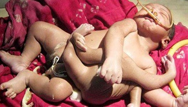 ولادة طفل بـ8 أطراف فى الهند
